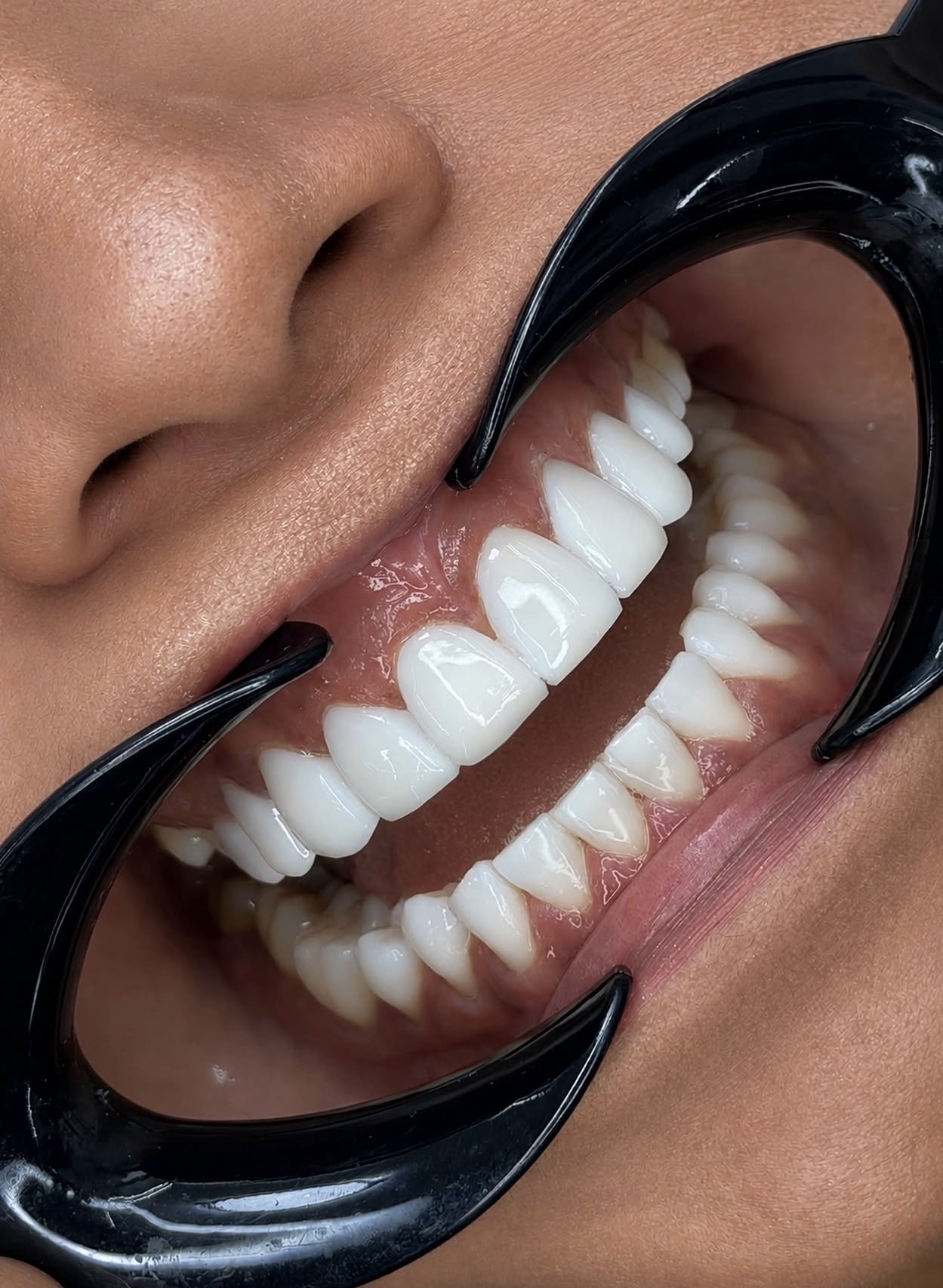 Diseño de sonrisa terminado